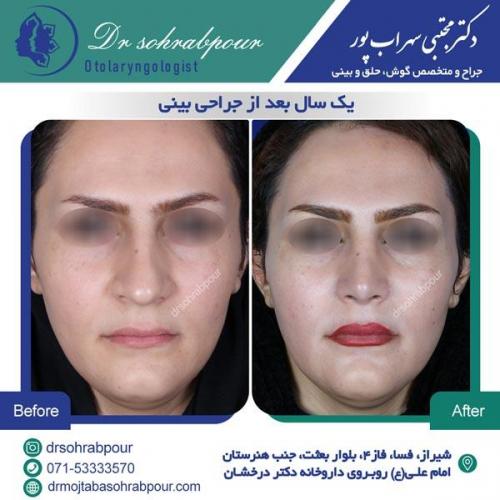 جراحی بینی در شیراز 29