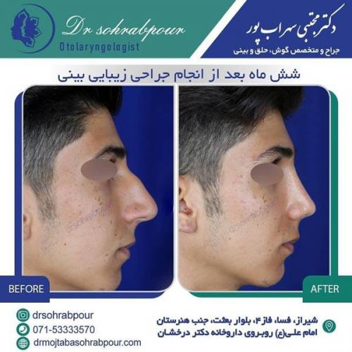 جراحی بینی در شیراز 3