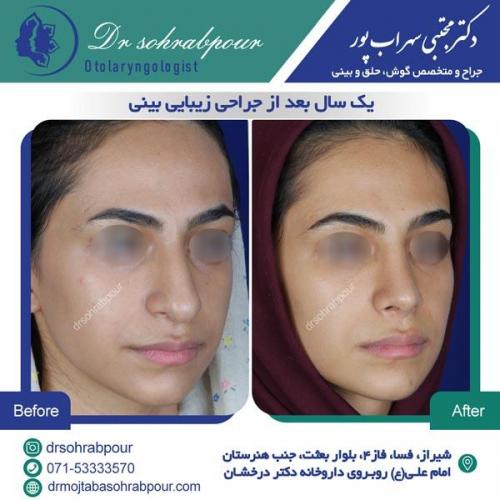 جراحی بینی در شیراز 30