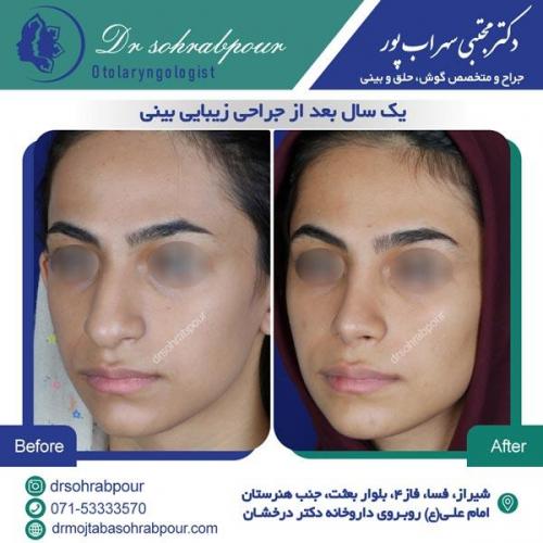 جراحی بینی در شیراز 31