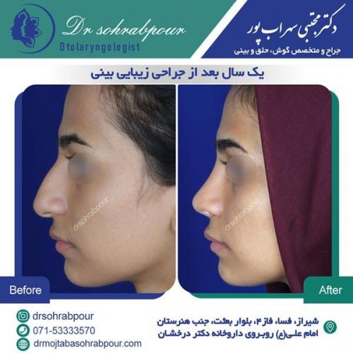 جراحی بینی در شیراز 32