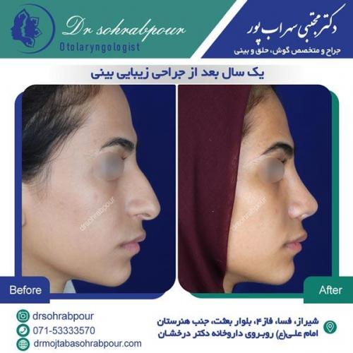 جراحی بینی در شیراز 33
