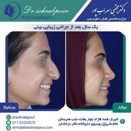 جراحی بینی در شیراز 34