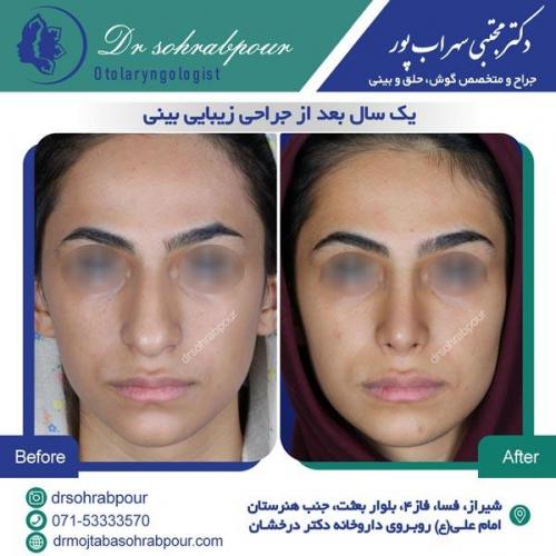جراحی بینی در شیراز 35