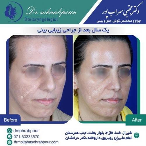 جراحی بینی در شیراز 36