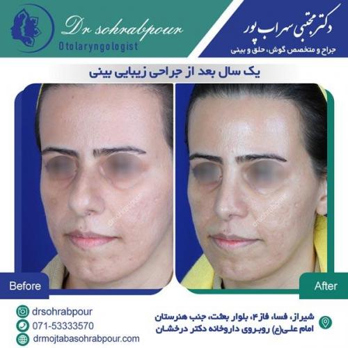 جراحی بینی در شیراز 37