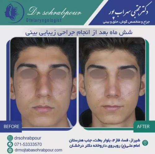 جراحی بینی در شیراز 4
