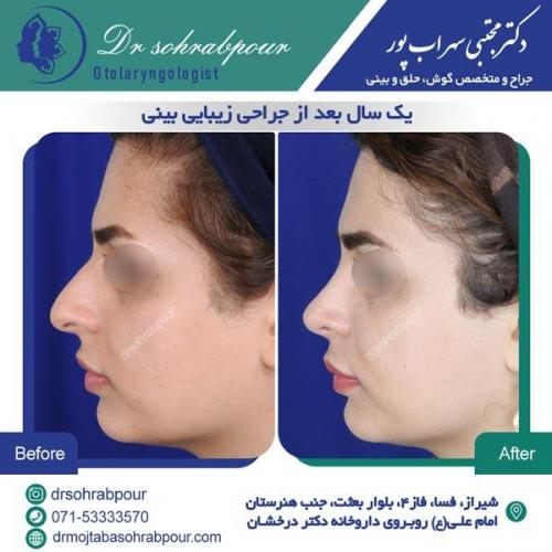 جراحی بینی در شیراز 45