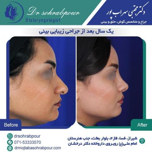 جراحی بینی در شیراز 48