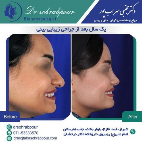جراحی بینی در شیراز 49