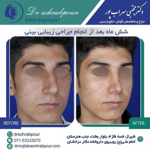 جراحی بینی در شیراز 5