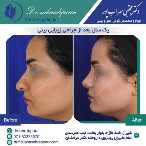 جراحی بینی در شیراز 50