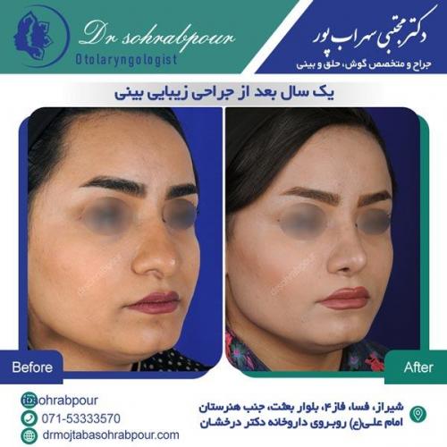 جراحی بینی در شیراز 51