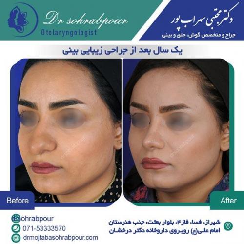 جراحی بینی در شیراز 52