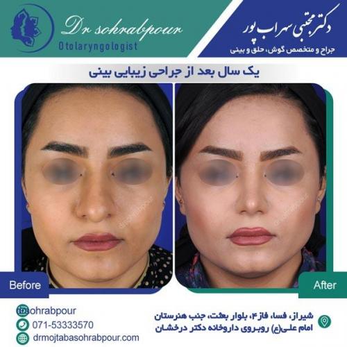 جراحی بینی در شیراز 53