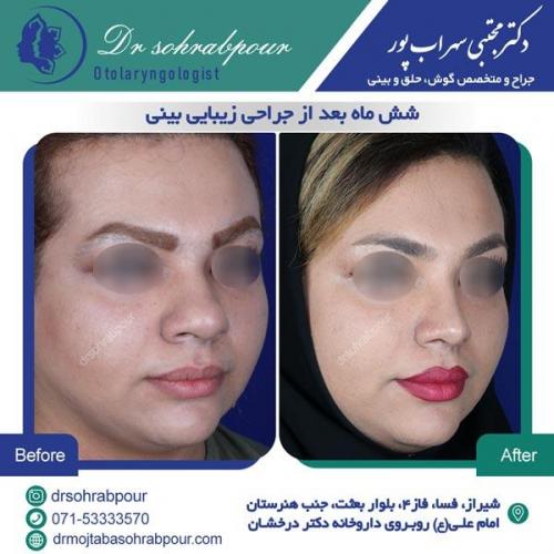جراحی بینی در شیراز 54