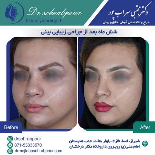 جراحی بینی در شیراز 55