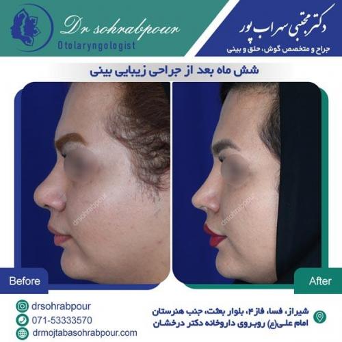 جراحی بینی در شیراز 56