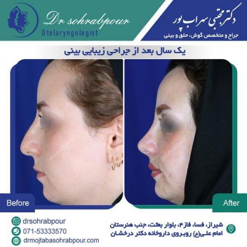 جراحی بینی در شیراز 68