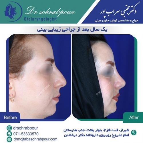 جراحی بینی در شیراز 69