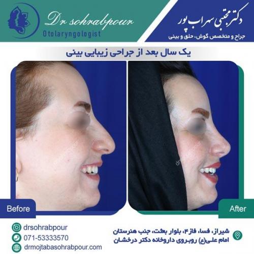 جراحی بینی در شیراز 70