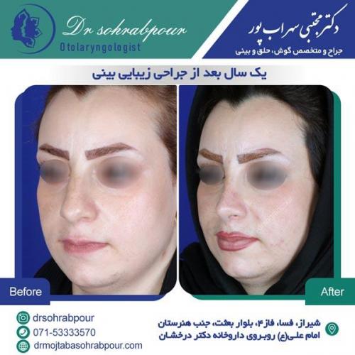 جراحی بینی در شیراز 71