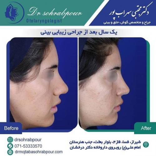 جراحی بینی در شیراز 72