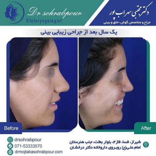 جراحی بینی در شیراز 73