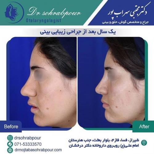 جراحی بینی در شیراز 74