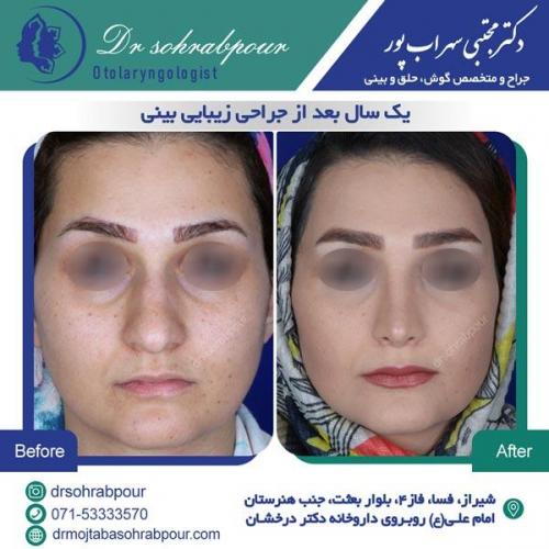 جراحی بینی در شیراز 80
