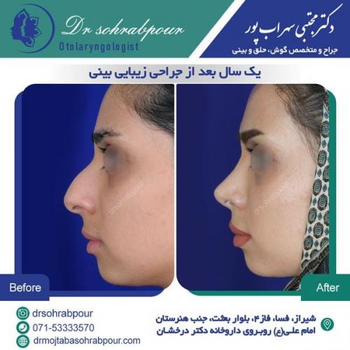 جراحی بینی در شیراز 84
