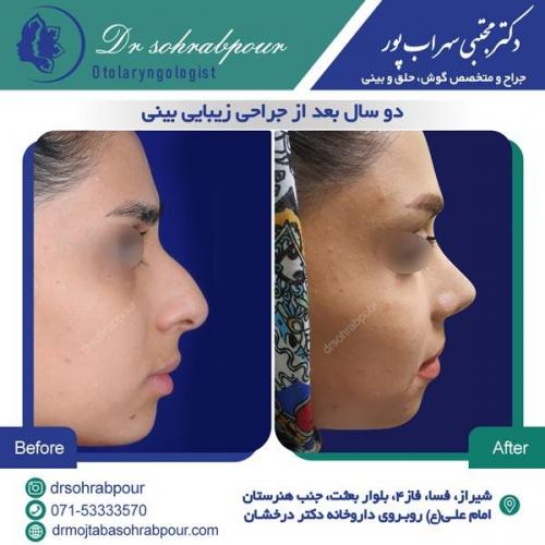 جراحی بینی در شیراز 85