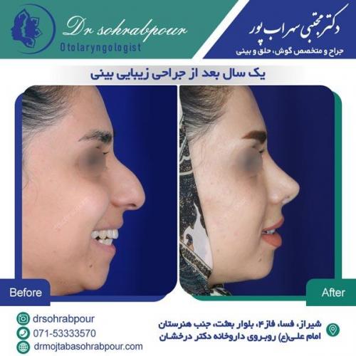 جراحی بینی در شیراز 86