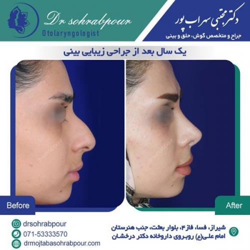 جراحی بینی در شیراز 87
