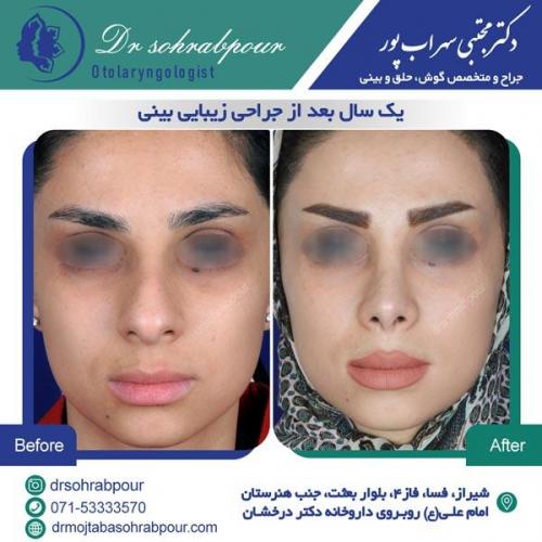 جراحی بینی در شیراز 89