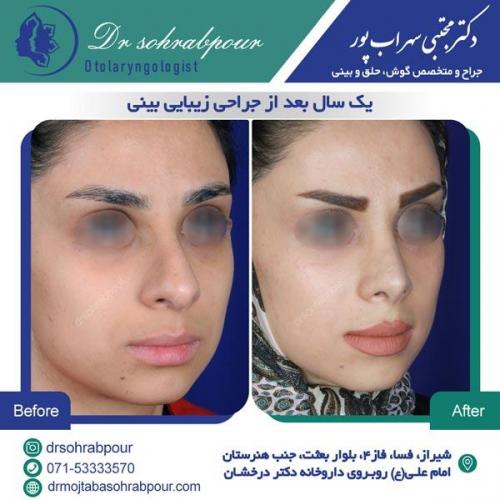جراحی بینی در شیراز 90