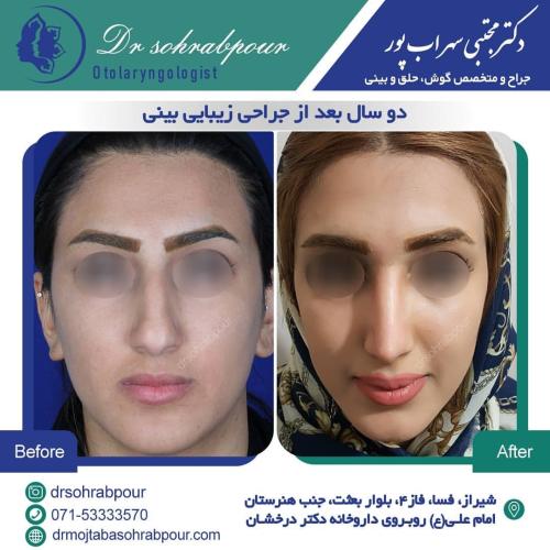 جراحی-بینی-در-شیراز184