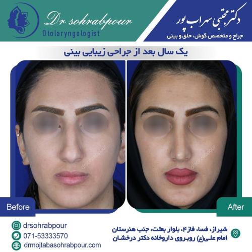 جراحی-بینی-در-شیراز185 (1) (1) (1) (1)
