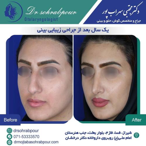 جراحی-بینی-در-شیراز186 (1) (1) (1) (1)