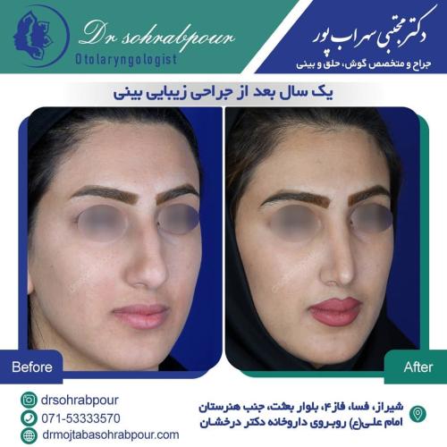 جراحی-بینی-در-شیراز187 (1) (1) (1) (1)