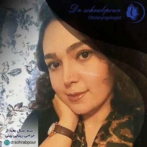 جراحی-بینی-در-شیراز189