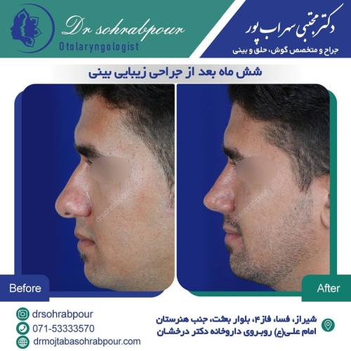 جراحی-بینی-در-شیراز190 (1) (1) (1)