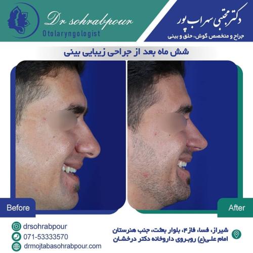 جراحی-بینی-در-شیراز191 (1) (1) (1)