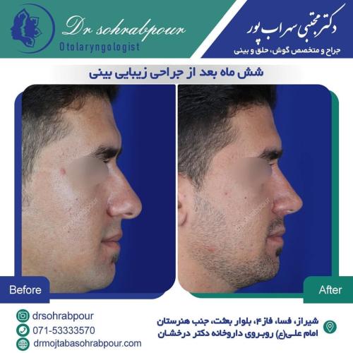 جراحی-بینی-در-شیراز192 (1) (1) (1)