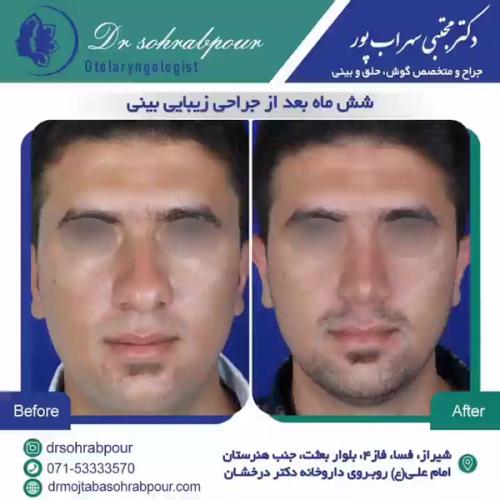 جراحی-بینی-در-شیراز193