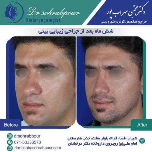 جراحی-بینی-در-شیراز194 (1) (1) (1)