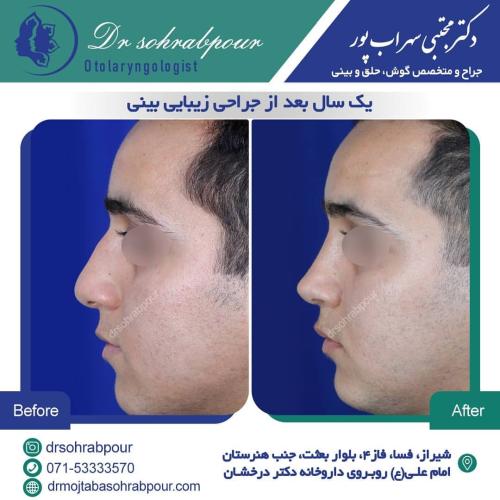جراحی-بینی-در-شیراز196 (1) (1) (1)