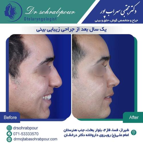 جراحی-بینی-در-شیراز197