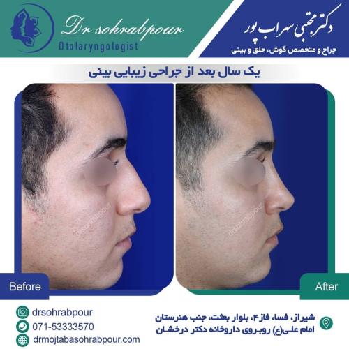 جراحی-بینی-در-شیراز198