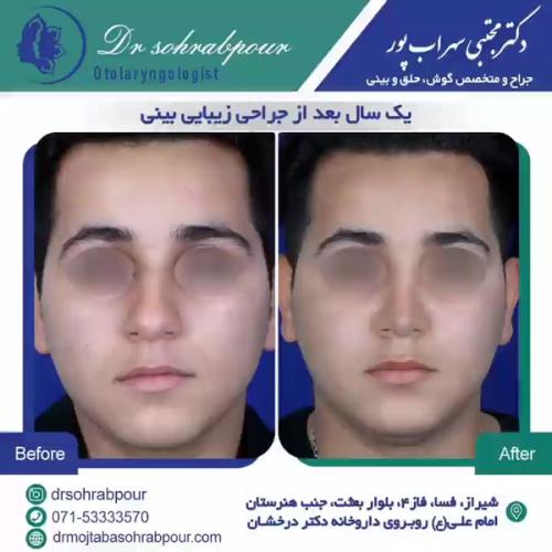 جراحی-بینی-در-شیراز199